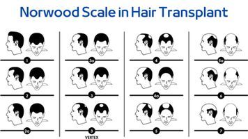 The Norwood -Hamilton Scale in Hair Transplant
