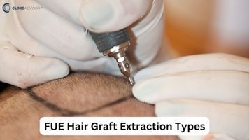 Everything you need to know about donor area harvesting in hair transplants