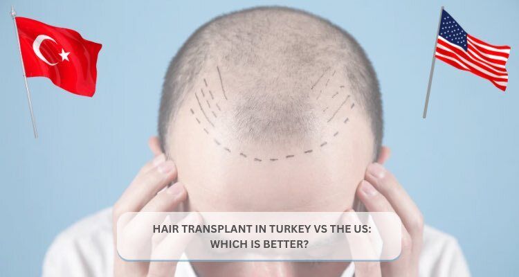 Hair Transplant in Turkey vs USA: Cost, Results & Key Differences Explained