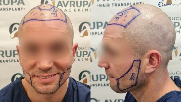 Here is My Hair Transplant Turkey Review