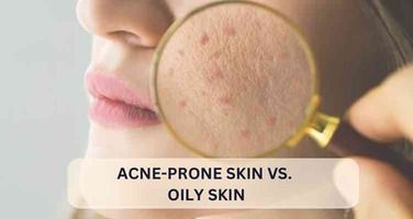 Acne-Prone Skin vs. Oily Skin: What’s the Difference and How to Care for Each?