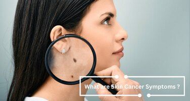 Skin Cancer Symptoms