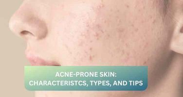 Understanding Acne-Prone Skin: Causes and Types